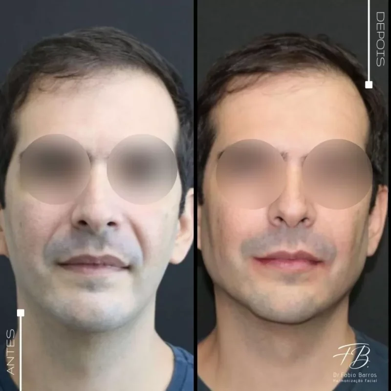 Inovação e Beleza: Conheça os resultados das Próteses Faciais com Dr. Fabio Barros